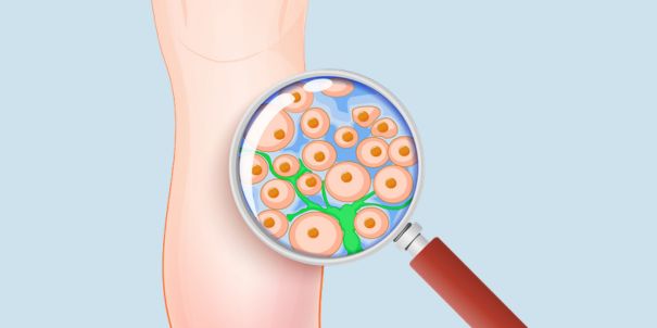 Lipödem erkennen: Typische Symptome